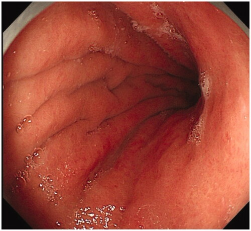 Figure 1. Mild atrophic gastritis, rough mucosa in the corpus, flattened rugal folds and absence of submucosal vessel.