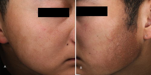 Figure 1 (A) the normal side of the right cheek. (B) a continuous area of brownish perifollicular macules with hypertrichosis on the left cheek.