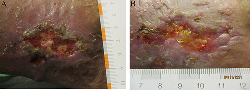 Figure 5 Case report (A) Ulcus cruris venosum with low exudate level and slough before wound management with the hydropolymer gel. The surrounding skin was dry. (B) Same wound after 4 weeks of regular wound management with the hydropolymer gel. A wound size reduction and debridement is visible.