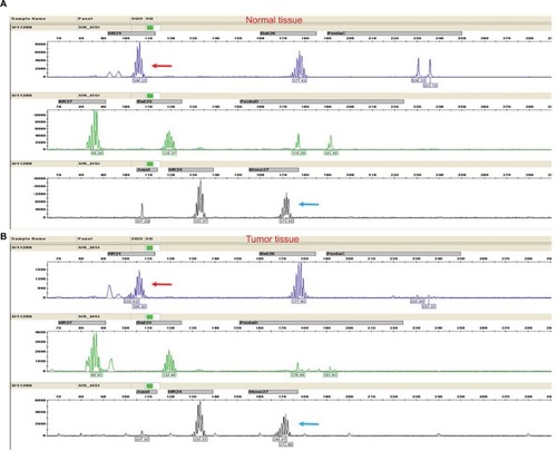 Figure 4 Capillary electrophoresis results from the MSI Multiplex System.Notes: The shift in the size (bases) of the amplification products from tumor tissue (B) compared with the normal tissue specimen (A) was observed at two mononucleotide repeat loci (NR-21 and MONO-27), while the two pentanucleotide repeats (Penta C and Penta D) remained unchanged. Red arrows represent the NR-21, and blue arrows represent the MONO-27.