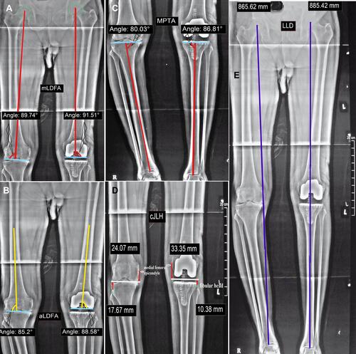 Figure 2 Assessment in coronal plane continued.