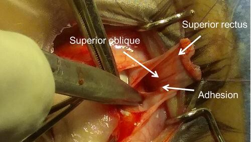 Figure 1 Figure showing the role of meticulous dissection to separate the superior rectus muscle from the underlying superior oblique muscle. This helps to minimize the risk of induced post-operative vertical deviations and ptosis.