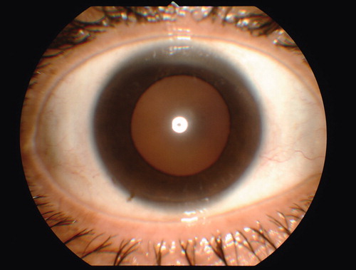 Figure 2.  Complete recovery of corneal endotheliitis 1 month after onset.
