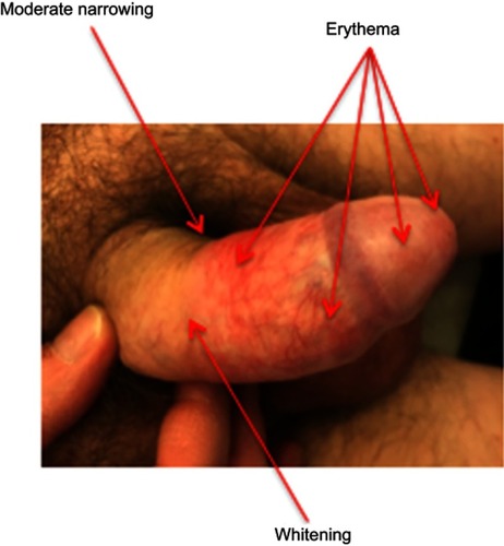 Figure 3 Early stage of BXO. Partial whitening and sclerosis of the preputial skin (moderate narrowing). Erythematous areas of the foreskin and the glans.