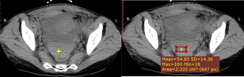 Figure 1 NCECT (left) and CECT (right) showing pelvic peritoneal hematoma (note the density of the hematoma: in the range of 50s and above here indicated is 54.85 HU).