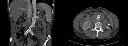 Figure 3 Seven weeks after the procedure and following active anti-infective therapy for 1 month, the bubble shadow around the abdominal aorta decreased but the low density liquid dark area was still visible.