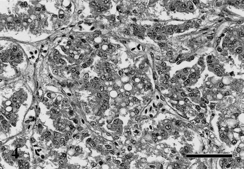 Fig. 4 Parathyroid gland showing proliferation of chief cells with cytoplasmic swelling and vacuolation. HE. Bar=50 μm.