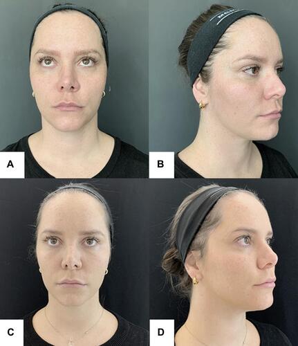 Figure 5 Woman, 29 years old; (A and B) Before procedure; (C and D) 180 days after procedure: evident slimming of the middle third of the face, turning more evident the triangle format of the face (Yarbus triangle).