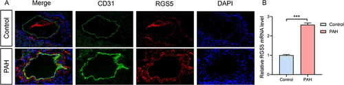Figure 8 RGS5 expression in PAH. (A) An Immunofluorescence staining of the pericyte marker (CD31) and RGS5 in pulmonary microvasculature of PAH mice. (B) Relative RGS5 mRNA expression in normal lung and PAH mouse samples. ***P<0.05.