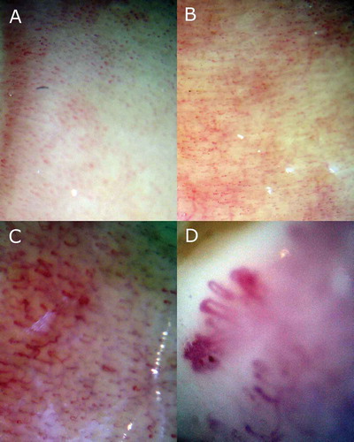 Figure 1. Normal-, early-, active-, and late-phase capillaroscopy patterns identified within the “scleroderma pattern”. A: normal-; B: early-; C: active-; D: late-phase nailfold capillaroscopy patterns