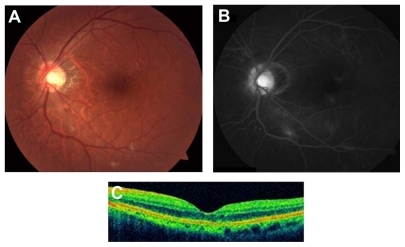 Figure 2 (A) Two months after treatment with intravitreal bevacizumab, the color fundus photograph shows a decrease of optic disc swelling, peripapillary hemorrhage, retinal exudates and microangiopathy. (B) Fluorescein angiography demonstrates improvement of optic disc and macular edema, and microaneurysms. (C) Optical coherence tomography (OCT) reveals complete resolution of serous retinal detachment.