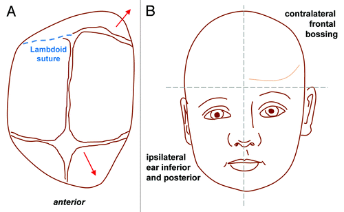 Figure 5. Lambdoid synostosis. Top view (A) and antero-posterior view (B) showing the direction of compensatory bone growth (red lines) following premature fusion of the lambdoid suture (blue dashed line). Lambdoid synostosis leads to ipsilateral flattening of the occipital region with a compensatory mastoid bulge which is a key distinguishing feature from positional (sometimes called positional or deformational) plagiocephaly from which it can be clinically difficult to differentiate. Contralateral growth in the parietal region is also noted and the cranial base becomes tilted.