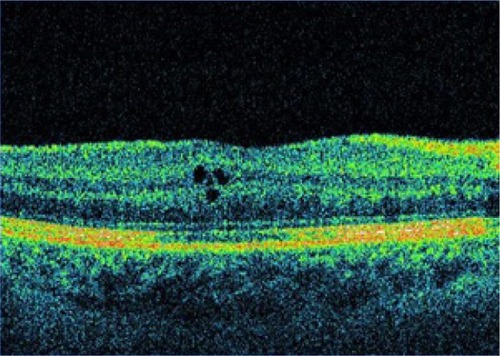 Figure 2 OCT 6 weeks after cataract surgery.Abbreviation: OCT, optical coherent tomography.