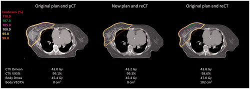 Figure 2. Example of a patient (PlanID 4) treated with a homogeneous dose to the right breast (16 x 2.66Gy) after surgical lumpectomy. Visualized are the original plan on the pCT, the adapted (new) plan on the re-CT and a re-calculation of the dose using the original plan on the re-CT, respectively. Notice the reduction in seroma on re-CT imaging, which was the reason for re-planning.