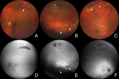 Figure 1 Wide-field color fundus photography and green-light fundus autofluorescence in lattice degeneration. (A) Color fundus photography of a highly pigmented perivascular lesion (arrowhead). (B) Color fundus photography of a moderately pigmented concentrical LD lesion (arrowhead) with chorioretinal atrophy (asterisk). (C) Color fundus photography of a mildly pigmented concentrical lesion (arrowhead). (D) Fundus autofluorescence shows hypointense signal from a highly pigmented perivascular lesion in (A). (E) Fundus autofluorescence shows hypointense signal from pigmented (arrowhead) and atrophic (asterisk) areas within the lesion in (B). (F) Fundus autofluorescence shows hypointense signal from the central part of the lesion in (C), while borders of the lesion are slightly hyperintense (asterisk).
