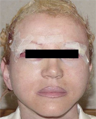 Figure 5 Appearance at 6 hours postoperatively with no drain placement.