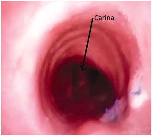 Figure 6. Postoperative bronchoscopy showing two bluish sutures over left lateral wall of trachea.