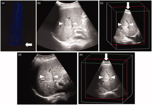 Figure 1. Comparison of three-dimensional ultrasound (3DUS) volume data images obtained by manual sweep scanning and AutoSweep scanning for an HCC lesion (maximum diameter, 28 mm) in segment VIII of the liver. (a) 3DUS volume data image obtained by manual sweep scanning. Blue lines indicate the locus of the manual sweep scanning. Arrow indicates the first frame of the manual sweep scanning. The distances between the blue lines are not equal, which indicates a non-constant scanning speed. (b) 3DUS volume data image obtained by manual sweep scanning. (c) 3DUS obtained by manual sweep allows viewing of the volume of interest in three orthogonal planes (this image shows plane B), which can be translated from right to left. The shape of the arc is not symmetrical due to the non-constant scanning speed (arrow). (d) US volume data image obtained by AutoSweep scanning. Comparison with the image in Figure 1(b) obtained by manual sweep shows that the images look almost the same. (e) 3DUS image obtained by AutoSweep allows viewing of the volume of interest in three orthogonal planes (this image shows plane B), which can be translated from right to left. Comparison with the image shown in Figure 1(c) obtained by manual sweep shows that the shape of the arc is symmetrical and the scanning range is slightly wider than that in the image shown in Figure 1(c) (arrow). Arrowhead indicates the margin of the HCC.