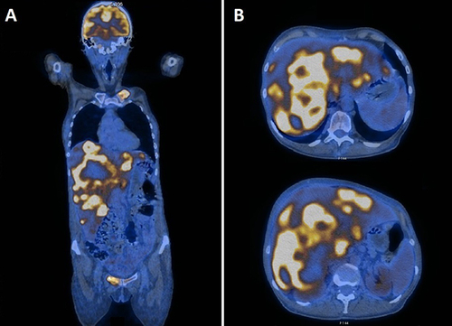 Figure 4 PET-CT: (A) overall image; (B) liver tumor.