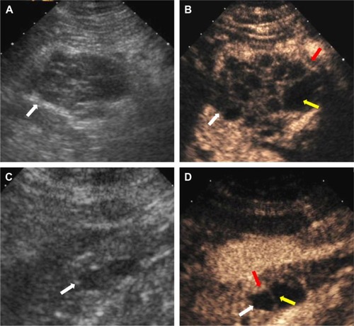 Figure 1 Serous cystadenoma diagnosed via surgical pathology from the pancreatic head in a 45-year-old man (A, B), and from the pancreatic head–neck in a 56-year-old woman (C, D).