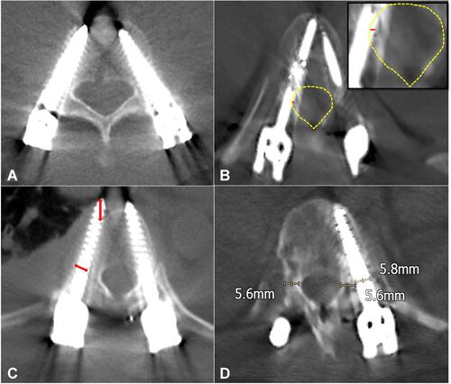 Figure 1 CT-image evaluation for pedicle screw breach. (A) Gertzbein–Robbins Grade A. The entire screw is intrapedicular. (B) Gertzbein–Robbins Grade B and medial breach grade I (red line: part of screw outside the cortex <2mm; yellow line: medial cortex). (C) Gertzbein–Robbins Grade D with lateral and anterior breach (red arrows: Part of screw outside the cortex 4–6 mm). (D) Gertzbein–Robbins Grade E with lateral breaching. Noted that almost entire screw diameter is outside the pedicle.