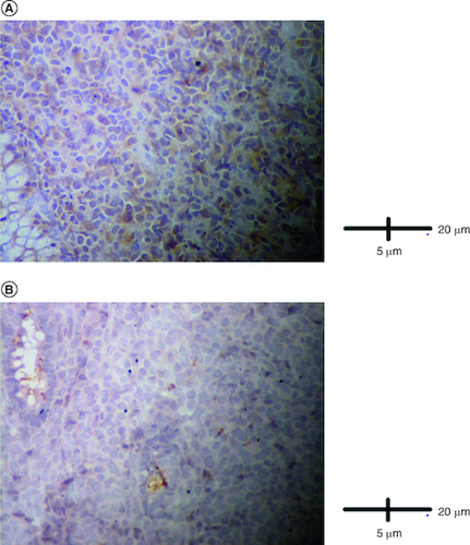 Figure 5. Immunohistological analysis.(A) Cells were negative for TdT (IHC × 400). (B) Cells were negative for ALK (IHC × 400).