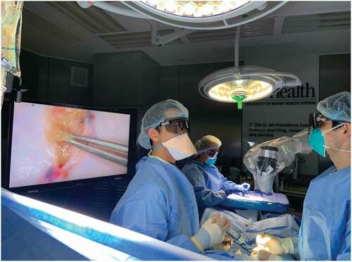 Figure 5. Operating room setup with the ORBEYE™ surgical microscope. The microscope coming from the surgeon’s left-frontal side is held over the surgical field resulting in no obstacle between the surgeon and the monitor. The operator, the assistant and the entire operating staff using 3D glasses have the same view as the operator