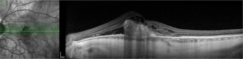 Figure 65 Spectralis® optical coherence tomography image (Courtesy of Roberto Gallego-Pinazo, MD).