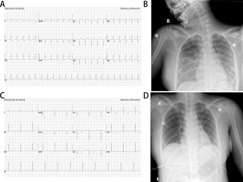 Figure 1 The dynamic changes of electrocardiogram and chest radiograph. (A) Electrocardiogram (ECG) showed QS complex only in V1-V3 leads and 1–2 mm ST-segment depression in II, III, aVF, V4-V6 leads on April 13th. (B) Chest radiograph showed bilateral pulmonary scattered inflammatory changes and possible pulmonary on April 13th. (C) Discordant terminal negative T waves in leads V1–V6 was observed in ECG on April 18th. (D) Chest radiograph showed no pulmonary congestion and obvious inflammation on April 19th.