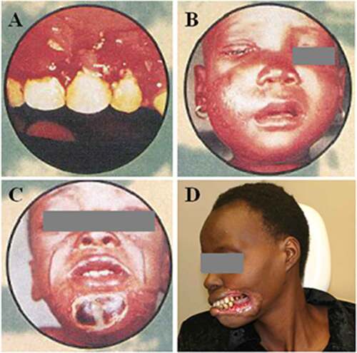Figure 1. Examples of manifestations in the four different stages of noma. (a) Stage 1, gingiva is red, bleeding and has lesions. (b) Stage 2, cheek is swollen. (c) Stage 3, a gangrenous plaque has occurred at the chin. (d) Stage 4, gangrenous tissue of left lip, left commissure and left cheek has fallen off, leaving a hole. (a–c) Property of WHO/AFRO and (d) property of Clemence Marimo. Reproduced with permission.