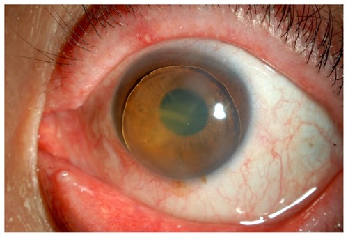 Figure 3 Preoperative anterior segment of the left eye in case 1.