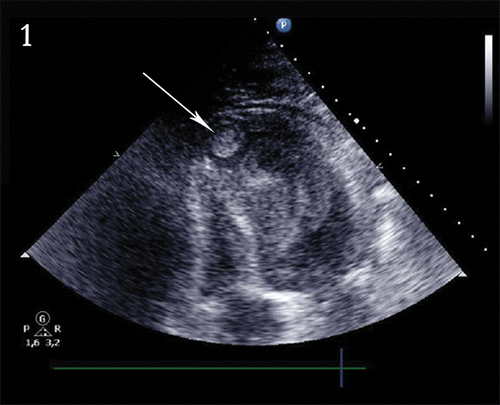 Figure 1. Cardiac ultrasound showing apical thrombus (arrow).