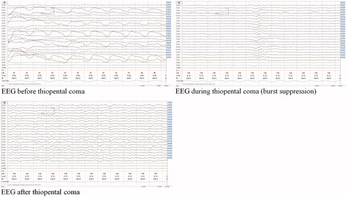 Figure 2. EEG pattern before, during and after thiopental-induced coma in our patient.