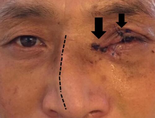 Figure 1 Patient with multiple sutures on his eyelid, canalicular laceration (arrows) and nasal septum deviation (dotted-line).