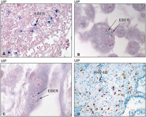 Figure 1. Representative photomicrographs of Epstein-Barr virus-encoded RNA (EBER) in-situ hybridization of lung biopsies from patients with IPF. The positive cells were seen predominantly in the parenchymal lymphocytic aggregates (A, arrow points at a positive mononuclear inflammatory cell, 300× magnification), but some specimens showed faint positivity in alveolar macrophages (B, arrow points at intracellular faint positivity, 1000× magnification). C shows a faintly positive activated alveolar epithelial cell nucleus (1000×) above a fibroblastic focus. D shows a representative photomicrograph (300×) of HHV-6 immunoreactivity in a frozen section from a patient with IPF/UIP. HHV-6B antigens were detected in parenchymal mononuclear inflammatory cells, morphologically appearing as macrophages or lymphocytes.