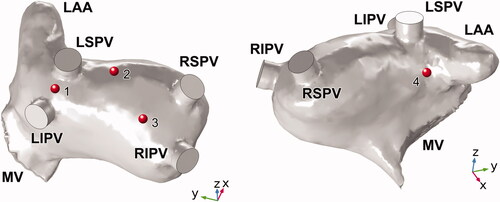 Figure 3. Selection of ablation sites on the endocardium of LA. LAA: left atrial appendage; LSPV/LIPV/RSPV/RIPV: left superior/left inferior/right superior/right inferior pulmonary vein; MV: mitral valve.