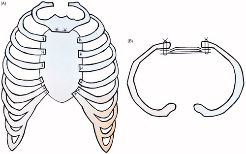 Figure 3. Cross section scheme of the sternal reconstruction with coronal plane (A), and axial plane (B). A layer of methyl methacrylate was sandwiched between two layers of a polypropylene mesh and sutured to the remaining ribs and muscles with polypropylene 3–0.