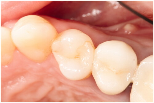 Figure 3. Tooth 14 OD (SBU/FZXT) superficial marginal discoloration at 36 months.