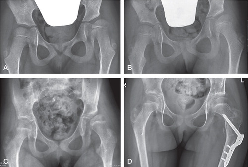 Figure 2. A.Preoperative radiograph of a 5 year 5 months old girl with spastic quadriplegia (GMFCS level V), showing subluxation of her left hip with migration percentage (MP) 50%. B. 1 year after soft-tissue releases, showing unsatisfactory primary correction; MP was reduced from 50% to 43%. C. 4.4 years postoperatively, showing poor outcome with MP 54% of the left hip. D. 3.1 years after Dega-type pelvic osteotomy and varus femoral osteotomy of the left hip (MP 31%).