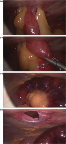 Figure 1. (a) Small-bowel preperitoneal incarceration in the site of the left port incision. (b) Incarceration was resolved laparoscopically. (c) Necrosis of the ileum was detected. (d) After resolving small-bowel incarceration small fascial defect was visualised.