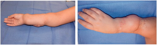 Figure 7. Long-term follow-up at age nine when the patient presented for flap revision with z-plasties and debulking.