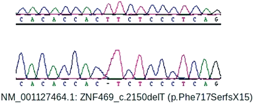 FIGURE 3  A DNA chromatogram showing that the patient harbored a novel homozygous base-pair deletion which caused a frameshift and premature protein truncation.