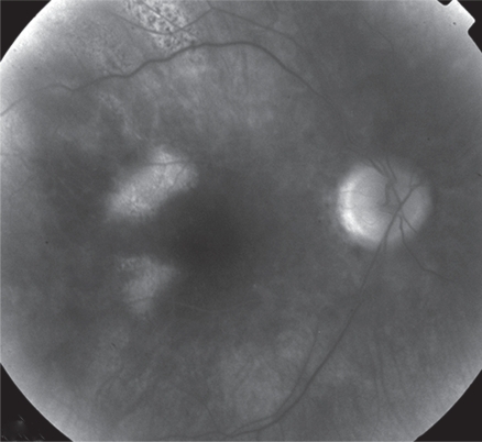 Figure 3 Fluorescein angiography OD reveals the hyperfluorescence of the optic disc due to vasculitis.