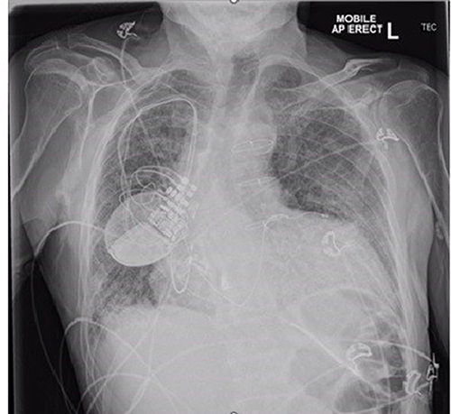 Figure 1 CXR image. Diffuse bilateral fine reticular interstitial densities. Peribronchial thickenings. Enlarged heart. No discrete consolidation.