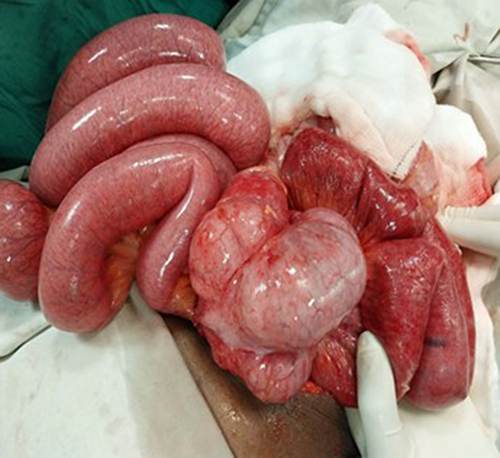 Figure 2 Intraoperative picture of the ileocecal knotting. The distal ileum appeared dusky up on initial evaluation which later regained it is normal color after the knot was released and warm pack.