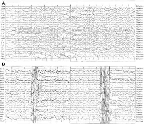 Figure 1 (A) Seizure with a left frontotemporal focus. Ictal electroencephalography (EEG) showed rhythmic and reluctant fast (12–13 Hz) activity primarily involving the left frontotemporal area consisting of polyspikes of about 100 mV amplitude with reversal phase in the F7 lead, then epileptic discharge involved all channels and showed a reduction in frequency (6 Hz). The patient was unconscious. Discharges consisting of high-amplitude sharp waves (90–100 μV) and slow waves (prominent on the frontotemporal areas) (high 30 Hz, low 0.1 second; rate 15 mm/second). (B) EEG during pseudoseizures. Normal background activity with interictal abnormalities in left frontocentrotemporal channels: sporadic and nonperiodic sharp waves at 100 mV with reversal phase on F7 and sporadic anterior synchronous and asynchronous theta activity (6–7 Hz, 50–60 mV). Muscular artifacts on right frontal derivations and two abrupt movement artifacts were concomitant with fictitious spasms of the patient. No epileptic seizures were recorded. This recording showed a significant reduction of interictal activity in comparison with her previous EEGs.
