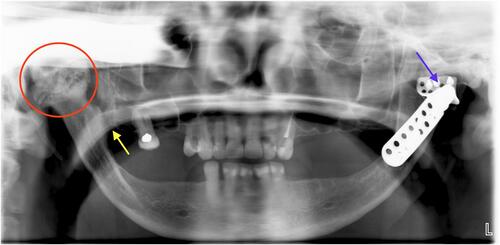 Figure 1 A panoramic radiograph taken at the time of the patient’s initial consultation revealed maxillary and mandibular partial edentulism. On the patient’s right side (left side of radiograph), there is an enlarged ankylotic mass fusing the mandible to the right base of the skull (circled in red), with impingement of the right maxillary tuberosity on the anterior aspect of the right mandible (yellow arrow). On the left mandible (right side of radiograph), there is a TMJ prosthetic implant with the mandibular condylar portion dislocated from the glenoid fossa component (blue arrow). Both mandibular coronoid processes are missing, having been surgically removed. The patient’s teeth are slightly apart – she can neither fully open nor close her mouth due to the bony fusion.