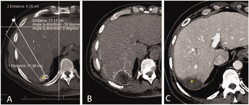 Figure 2. CT during hepatic arteriography (CTHA) on a patient with colorectal liver metastasis undergoing liver ablation. (A) CTHA prior to MWA antenna placement to localize target tumor (*); (B) postablation CTHA demonstrating large ablation zone (dotted line) around the treated tumor, which is no longer visualized; (C) 32-months CT follow-up demonstrating involution of the ablation zone without recurrence (*).