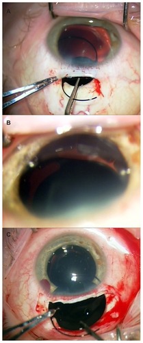 Figure 1 Opaque intraocular lens insertion during several different procedures of Case 2: (A) Insertion of a Morcher (type 80D) opaque intraocular lens into the lens capsular bag through a scleral tunnel incision; (B) Following the second operation of Case 2, there was still a visible gap between the dual castellated rings and the central black intraocular lens, allowing a crescent of red reflex to show; (C) Custom-made black implant of 10 mm “optic” diameter being inserted into the eye.