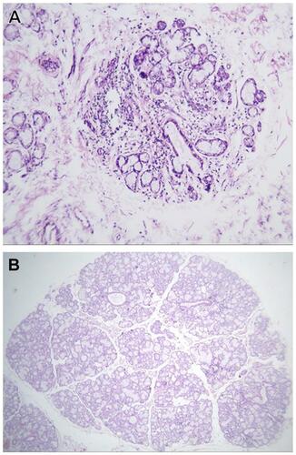 Figure 4 H&E-stained labial salivary glands (LSGs).Notes: (A) LSGs exhibiting nonspecific chronic sialadenitis with scattered lymphocytes and plasma cells (original magnification 100×). (B) LSGs exhibiting normal glands (original magnification 40×).